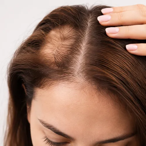 Alopecia Hair Wigs